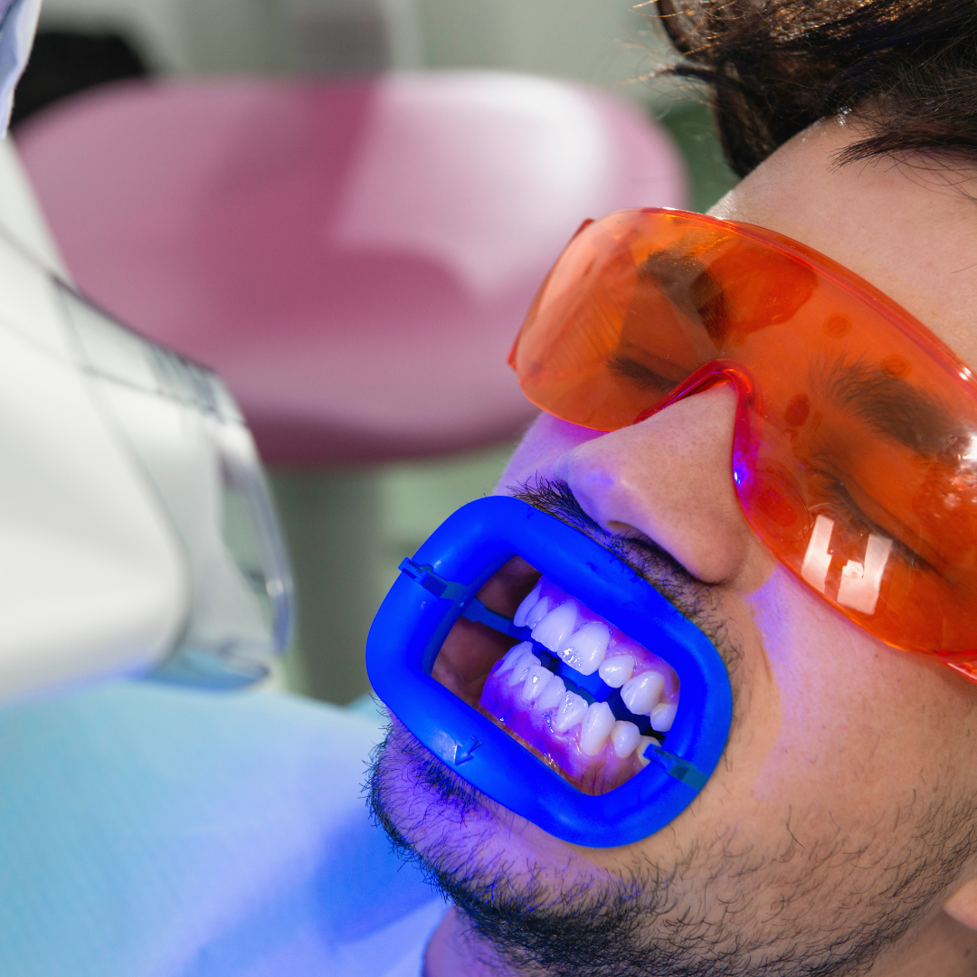 teeth-whitening-in-woodland-hills teeth-whitening-in-woodland-hills