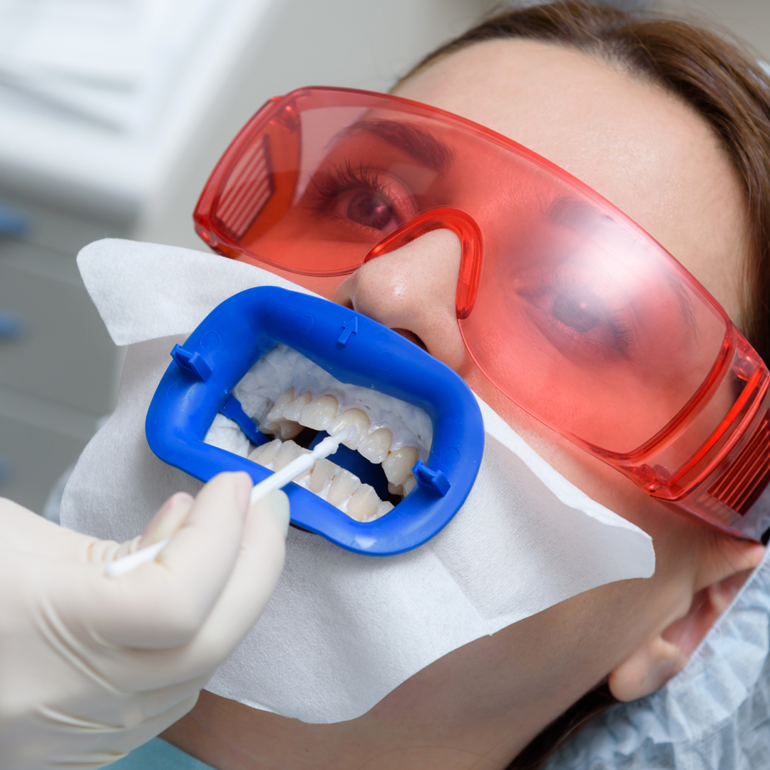 teeth-whitening-in-woodland-hills teeth-whitening-in-woodland-hills