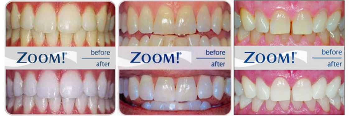teeth-whitening-in-woodland-hills teeth-whitening-in-woodland-hills
